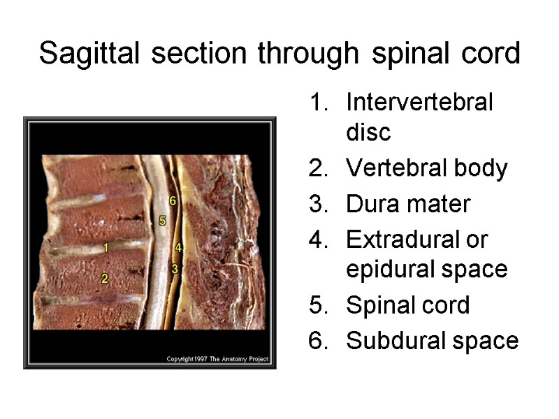 Sagittal section through spinal cord Intervertebral disc  Vertebral body  Dura mater 